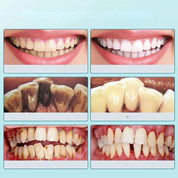 FreshScale – ultradźwiękowy eliminator płytki nazębnej i kamienia nazębnego 2