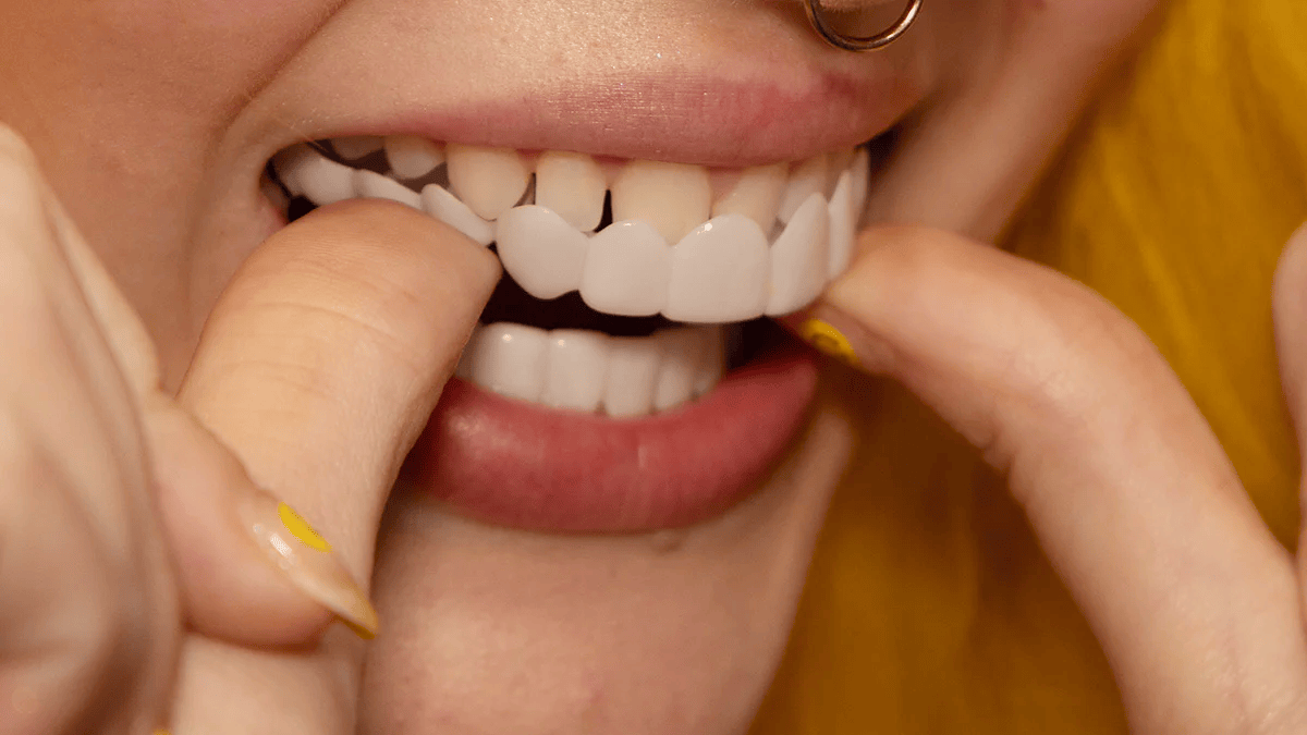 Natychmiastowa transformacja uśmiechu dzięki licówkom Snap on Smile 6